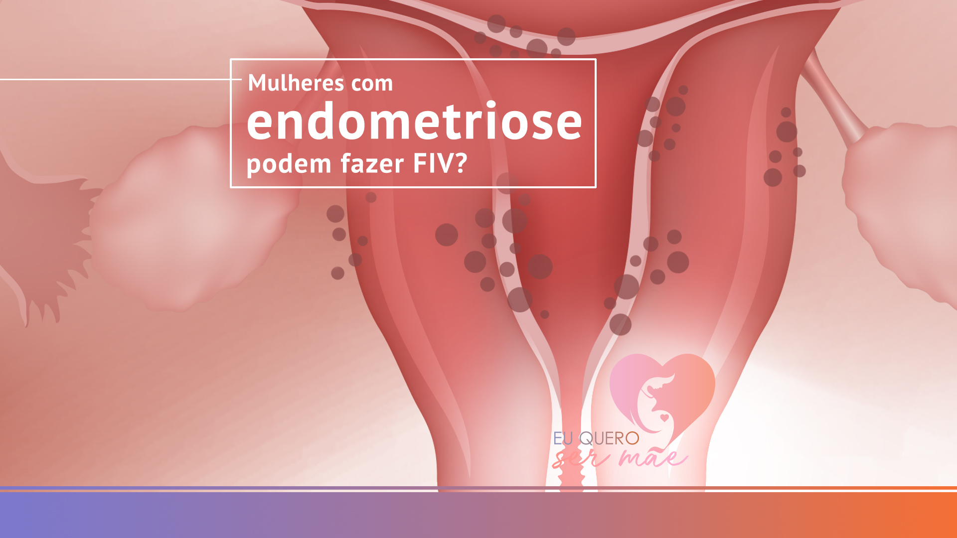 Mulheres com endometriose podem fazer FIV?